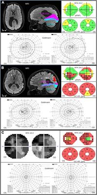 Pre- and Postnatal Damage to the Retro-Geniculate Visual Pathways Cause Retinal Degeneration Predictive for Visual Function